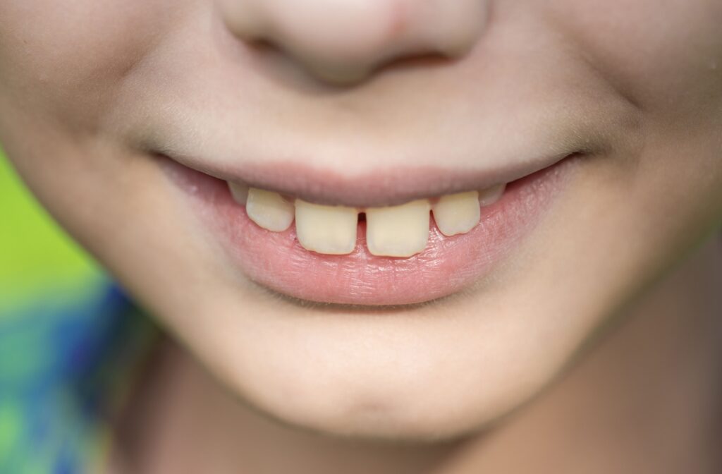 Close-up of a young child smiling, showing spaces between his teeth and an overbite.