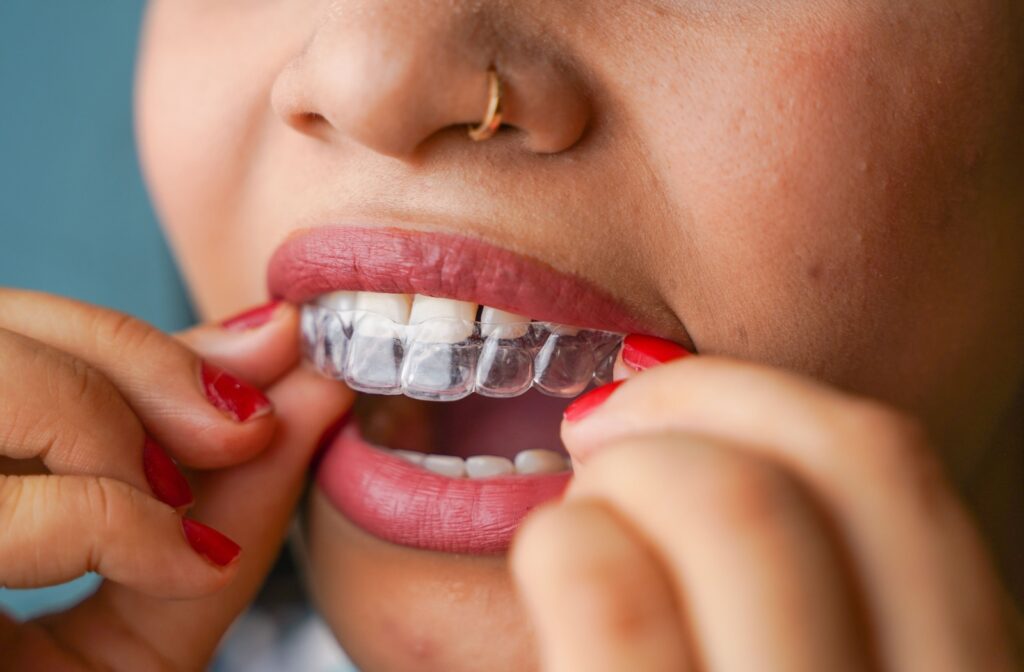 Close-up of woman inserting clear Invisalign aligner onto upper teeth.