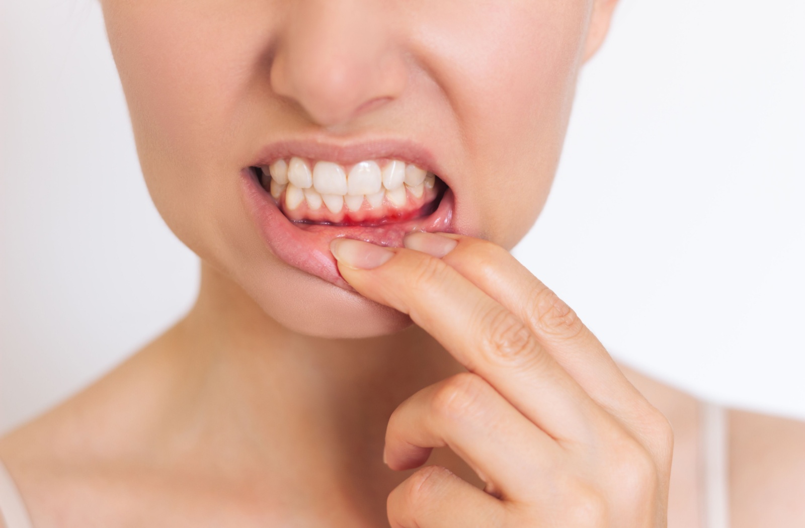 Person pulling their lip down to show their swollen gums caused by flossing