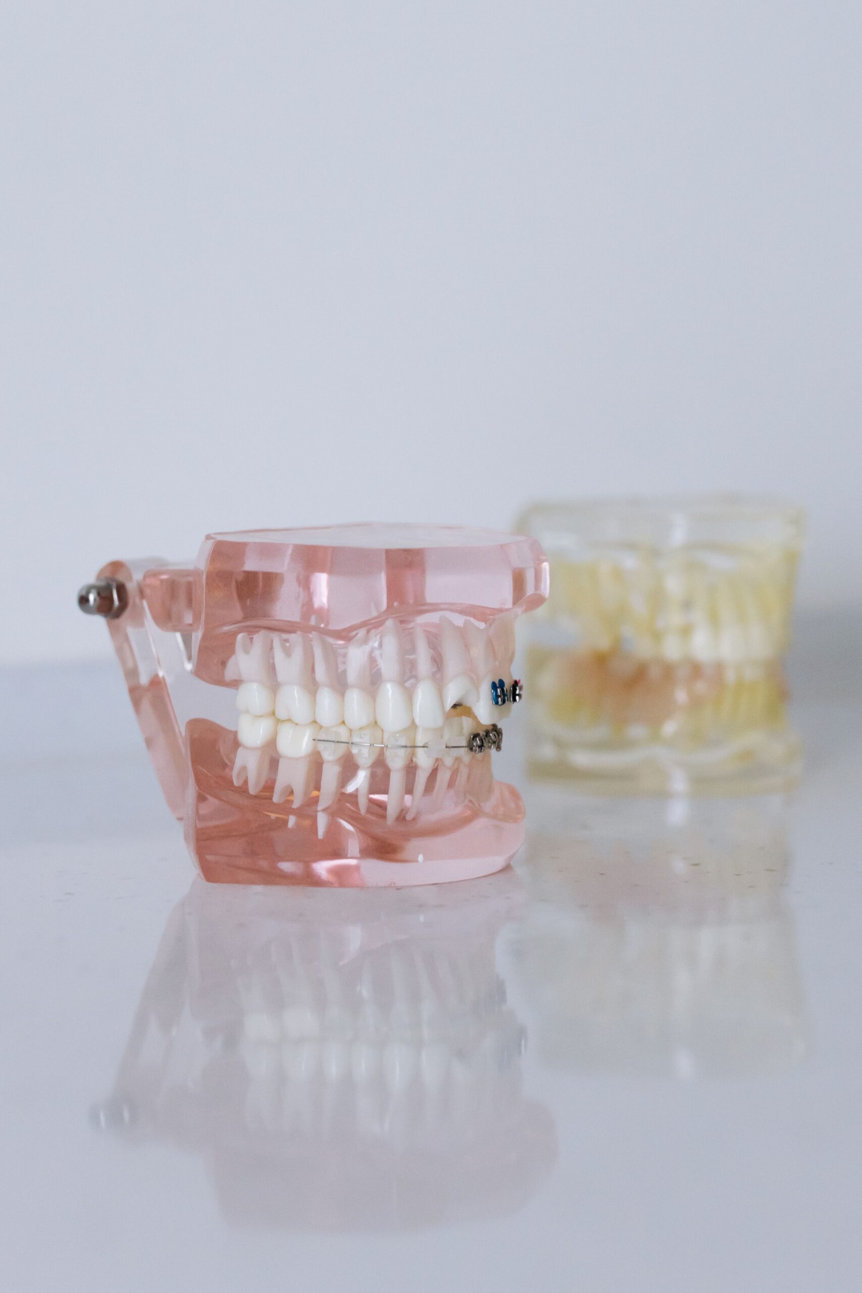 Implant retained dentures