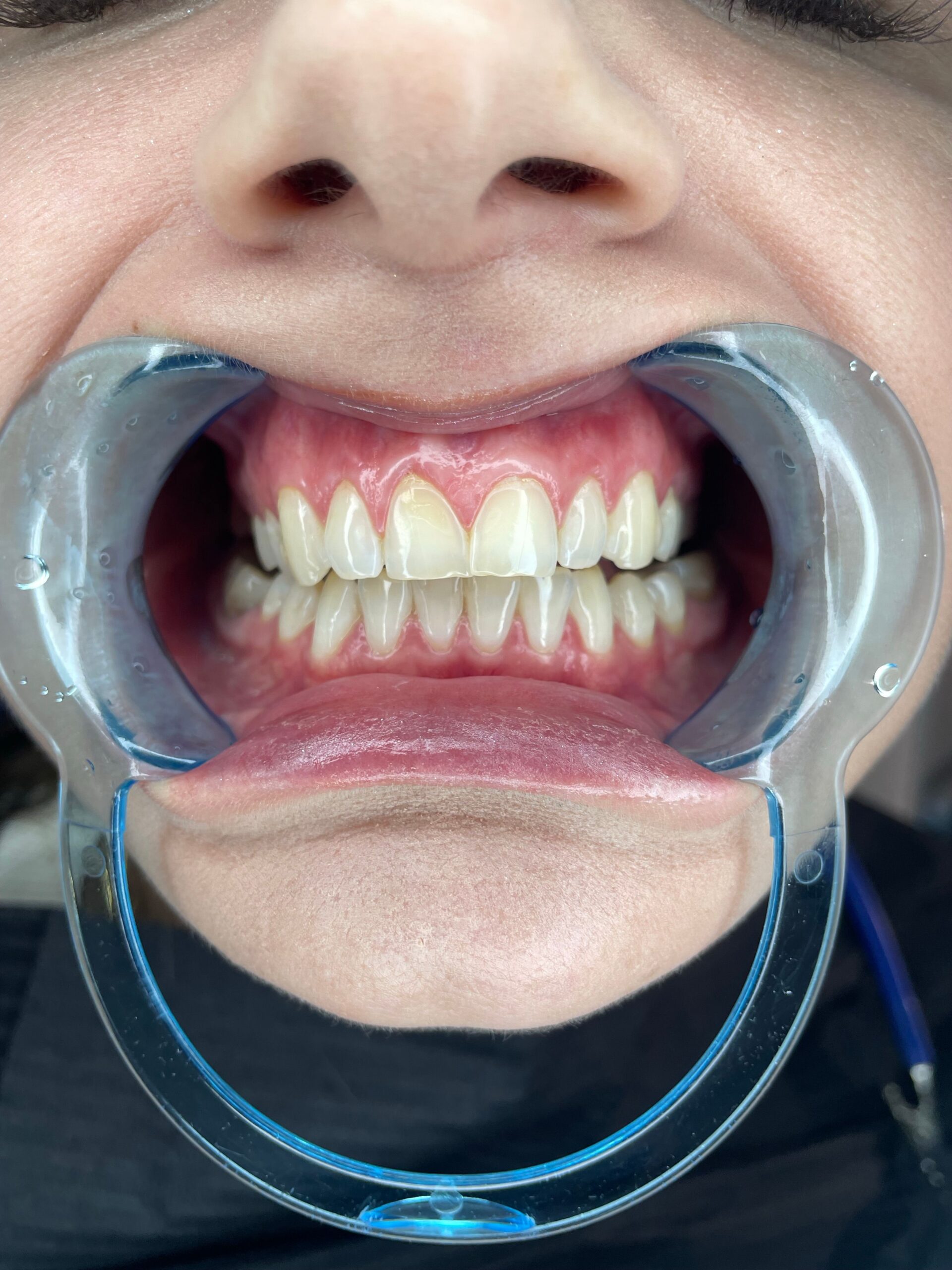 A dental professional discussing a tooth shade with a patient