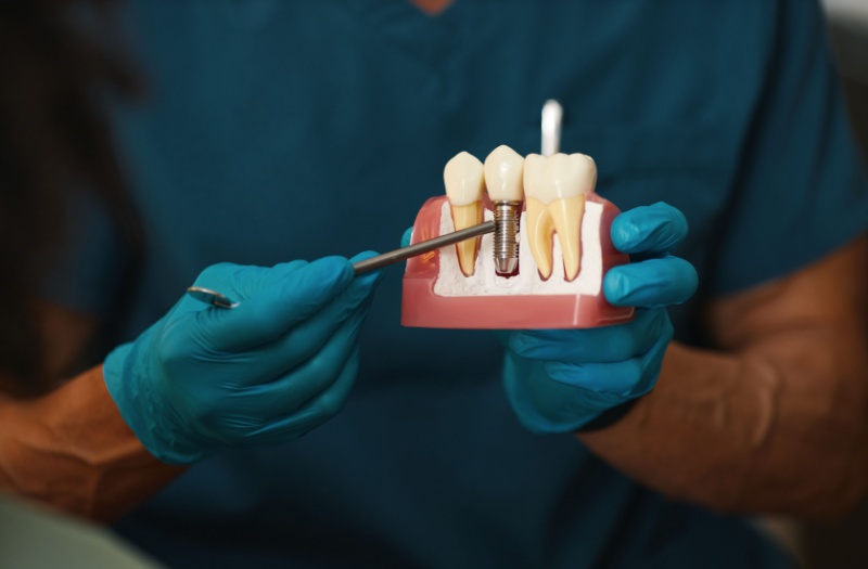 Dentist pointing to a dental implant on a 3D model